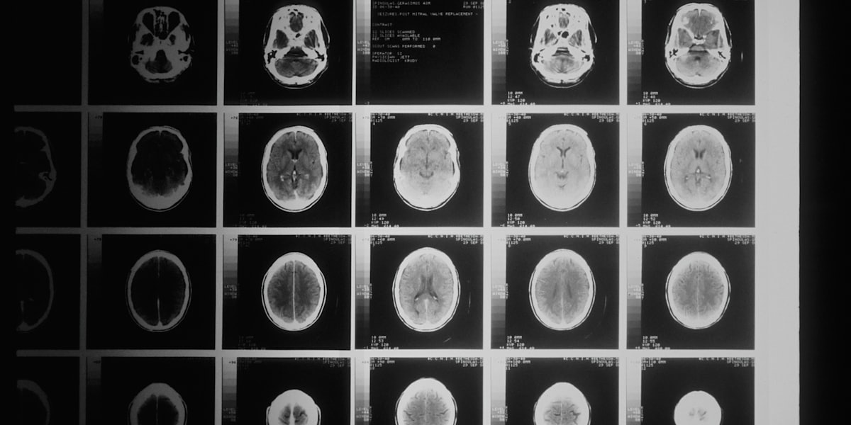 Sheet of MRI brain slices on a light box